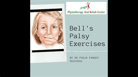 bell palsy in spanish